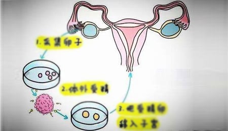 试管婴儿IVF
