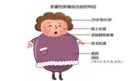 多囊卵巢症状