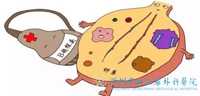 多囊会自己排卵吗