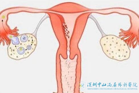 输卵管梗阻做试管婴儿