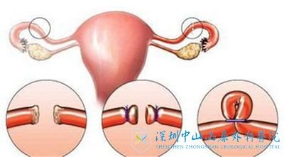 多囊治疗的时间会受多个因素的影响