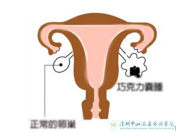 巧克力囊肿是什么病