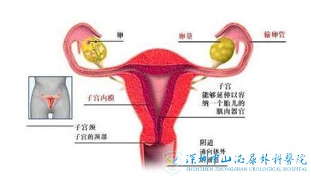 经血逆流导致巧克力囊肿