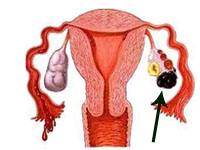 巧克力囊肿是怎么回事呢,会影响到怀孕吗