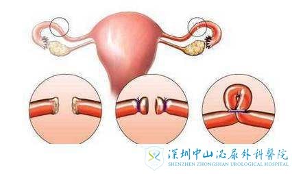 假如输卵管切除了做试管还能成功吗