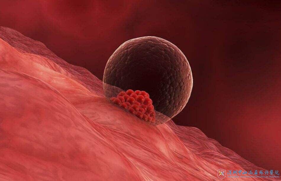 子宫内膜异位可以做试管婴儿