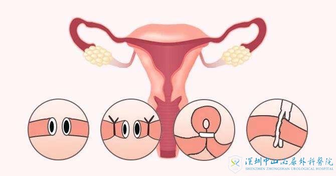 做试管女性的输卵管有病变了会影响吗