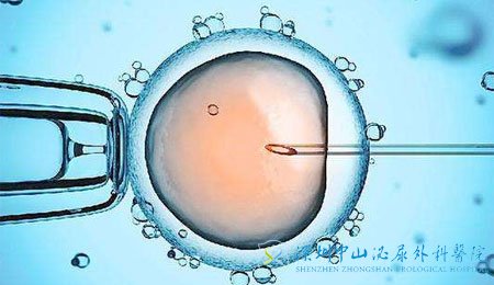 试管婴儿