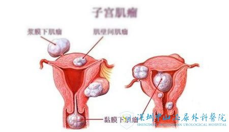 子宫肌瘤