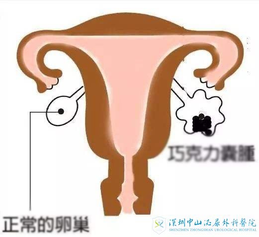 巧克力囊肿对试管会影响吗