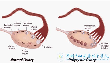 多囊卵巢综合征