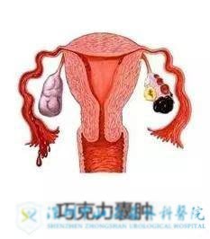 巧克力囊肿做试管还能成功吗