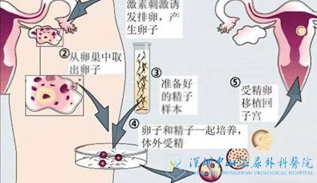 试管婴儿流程