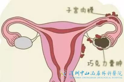 巧克力囊肿该如何治疗还能做试管吗