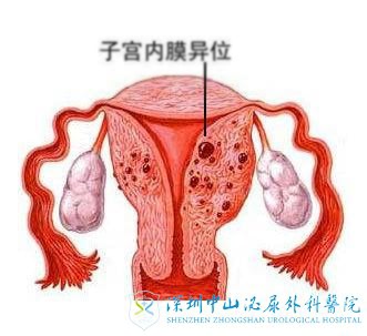 子宫内膜异位症做试管胚胎能顺利着床吗