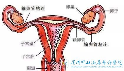 输卵管粘连有什么症状会影响做试管吗