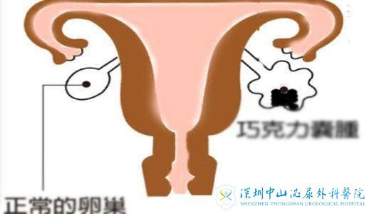 巧克力囊肿会恶变影响到试管婴儿吗