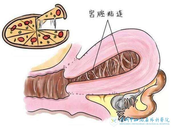 宫颈粘连还能做试管吗