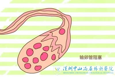 输卵管堵塞能做二代试管吗