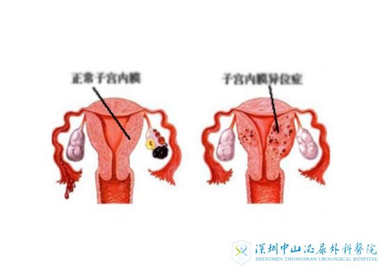 巧克力囊肿复发了还能进行试管治疗吗