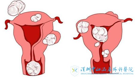 子宫肌瘤