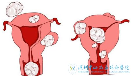 子宫肌瘤