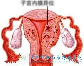 子宫内膜异位怎么生孩子,其实可以考虑试管婴儿助孕