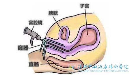 宫腔镜检查