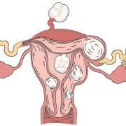 子宫肌瘤常发于哪个年龄段,还能做试管婴儿吗