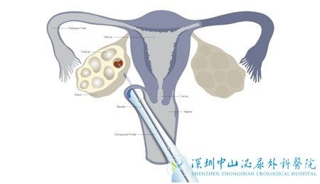 取卵过程大揭秘：了解取卵手术的具体细节 (取卵的流程原来是这样!今天可算明白了!)