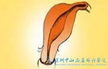 宫腔发育异常会影响试管婴儿妊娠率吗