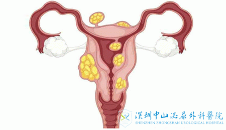 子宫肌瘤