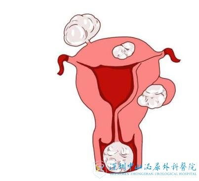 试管婴儿移植之前被查出有子宫肌瘤该怎么办
