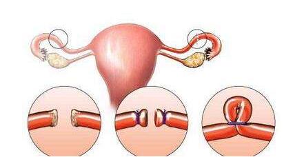 输卵管结扎了复通好还是试管婴儿好