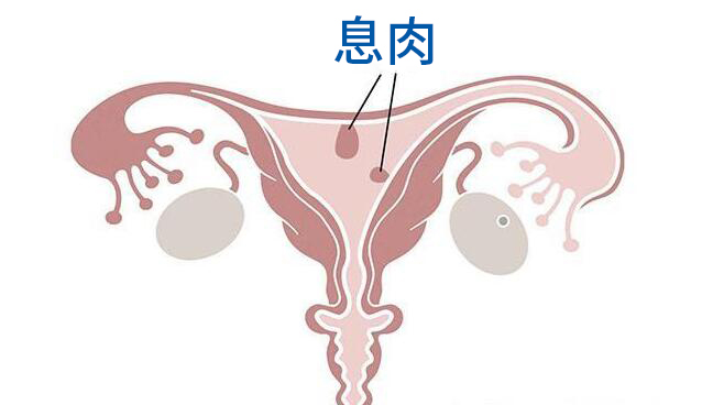 医生前几天说有宫腔息肉会不会影响以后的试管婴儿移植