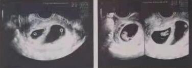 结婚未孕去做一代试管婴儿超声监测有什么意义